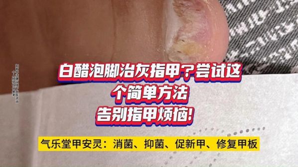 灰指甲根治的方法 灰指甲的治疗方法用醋